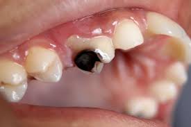 Tooth Decay Signs You Should Watch Out For