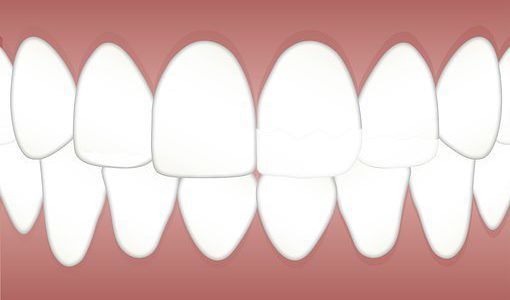 How to Get Rid of Yellow Teeth Overnight
