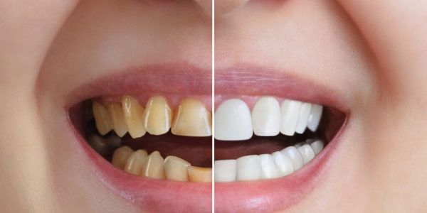 Smile Make over: Improving Color and Texture of Teeth